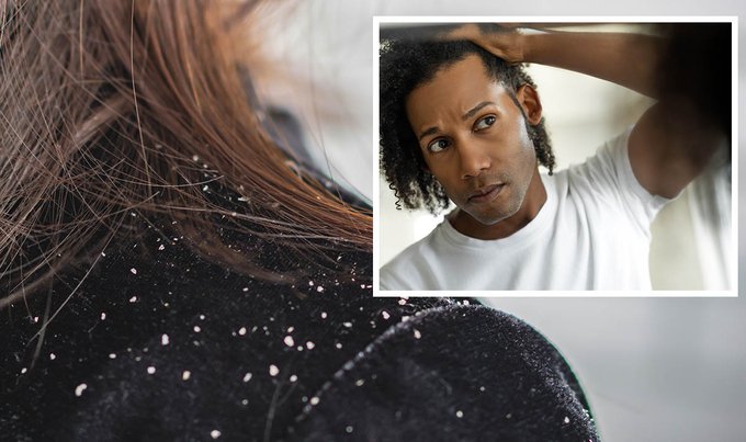 Get rid of dandruff with simple ingredients,home made products Get rid of dandruff with simple ingredients,home made products