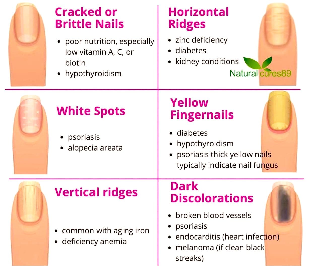 Deformities, Dystrophies, and Discoloration of the Nails - Skin Disorders -  MSD Manual Consumer Version