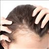 Having Vitamin D deficiency leads to Hair loss 