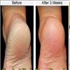 Treatment for cracked heels at home 