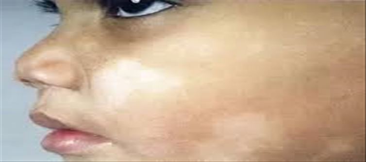 Which Vitamin Deficiency results in White Spots?