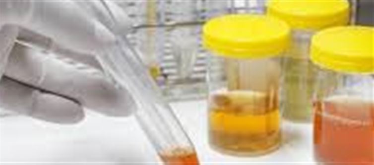 Kidney Damage: If the Color of Urine Changes to This, Understand That the Kidneys Are Starting to Rot