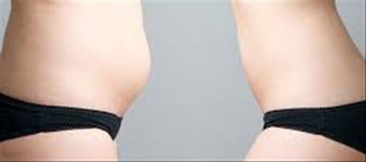 Still Have a Postpartum Belly? It May Be Diastasis Recti, Not Fat