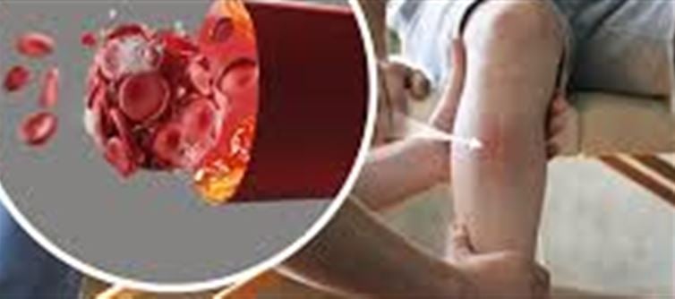 Swelling in the Feet Can Signal Heart Risk – What is Peripheral Artery Disease (PAD)?