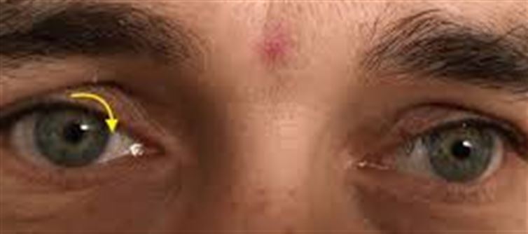 Why Does My Eye Keep Twitching?