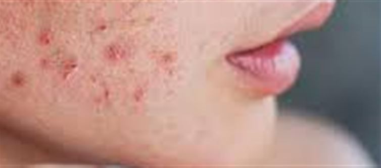 Why Does My Skin Break Out Before My Period?