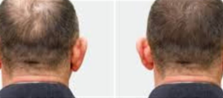 💇♂️ Undetectable Hair Transplants: How Men Are Restoring Hair Without Shaving