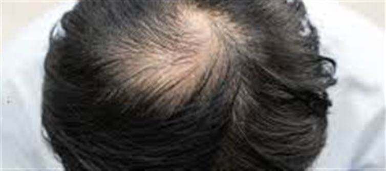 Ancient Chinese Medicine Could Hold the Secret to Hair Regrowth