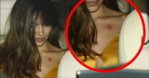 Celebrities Caught Publically Flaunting LOVE BITES on Body Photos