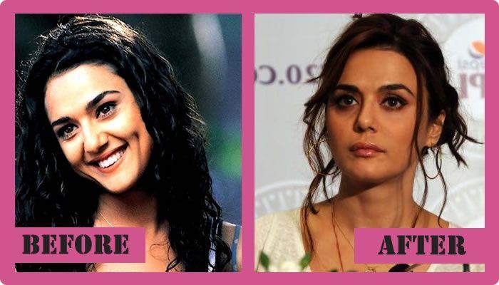 Celebs Before and After Cosmetic Surgery