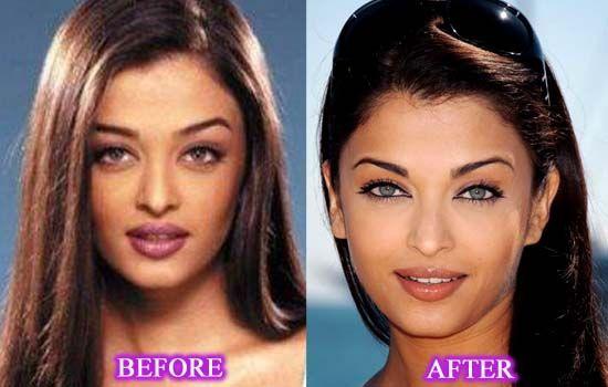 Celebs Before and After Cosmetic Surgery