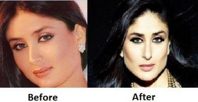 Celebs Before and After Cosmetic Surgery