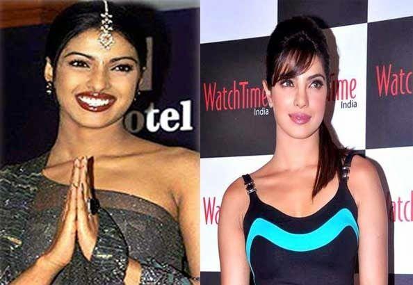 Celebs Before and After Cosmetic Surgery