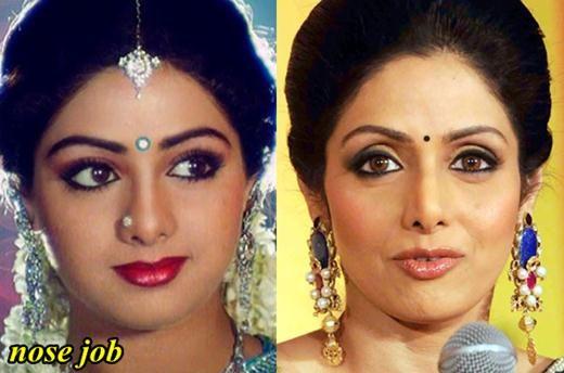 Celebs Before and After Cosmetic Surgery