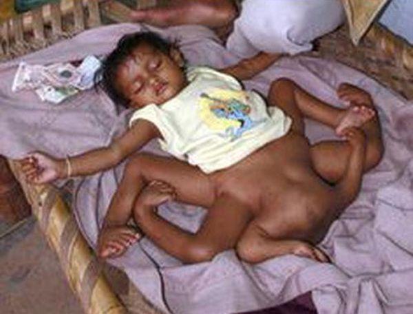 Medical Birth Miracles From Around The World That Are Shocking
