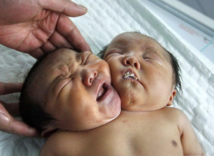 Medical Birth Miracles From Around The World That Are Shocking