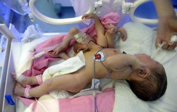 Medical Birth Miracles From Around The World That Are Shocking