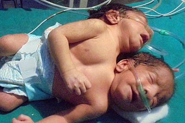 Medical Birth Miracles From Around The World That Are Shocking