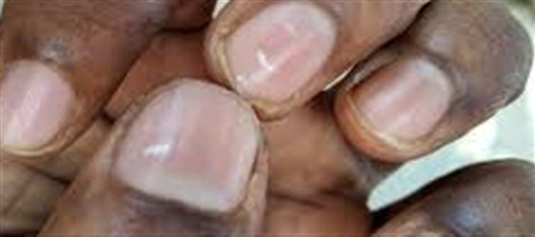 White Spots on Your Nails? It Could Be a Vitamin Deficiency