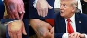 #TrumpIsDead Hoax: The Bruised Hand Behind the Viral Rumor..!?