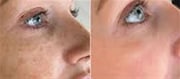 What Are Chemical Peels And Are They Secure?