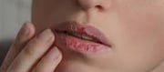 Which vitamin deficiency causes chapped lips?