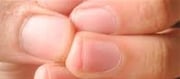 Test Your Hands For Signs And Symptoms Of High Ldl Cholesterol,