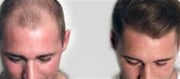 Whilst Is The Right Time To Get A Hair Transplant?