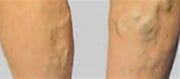 Worn-Out Legs May Indicate Varicose Veins Issues.