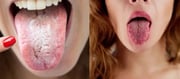 Does Your Tongue Have a White Coating or Look Bright Red? What it tells about your Health?