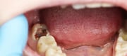 One in Three Indians Have This Common Disease - 80% Doesn't Know Why Teeth Rots?