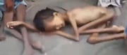 There's Famine In Yemen For A Decade - 90000 Children Died and 10 Million Are Starving