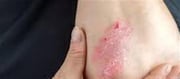 Don’t forget about excessive blood stress