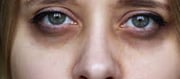 Why do dark circles occur under the eyes?