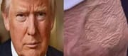 Donald Trump is suffering from this serious vein disease...