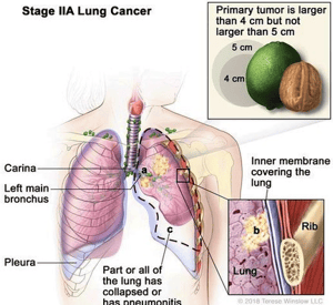 Lung cancer