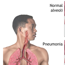 Pneumonia