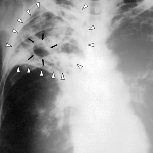 Tuberculosis