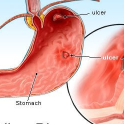 Ulcer