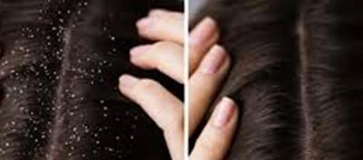 Dandruff Results From Scalp Health And Conditions