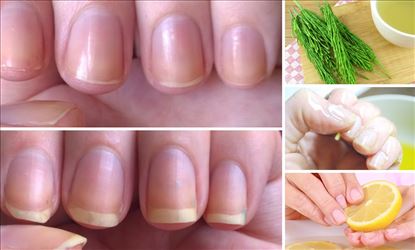 Best Vitamins needed for Nail Growth 