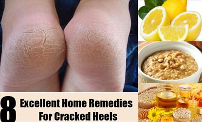 BEAUTY : Remedies for cracked heels