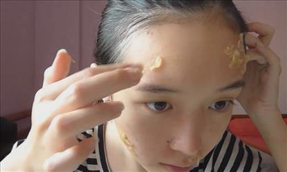 Natural home remedies to get rid of pimples