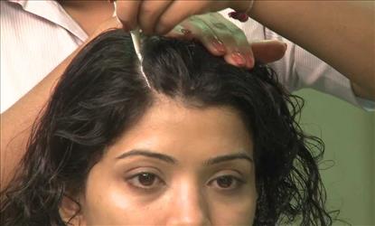 How to get rid of Dandruff naturally? 