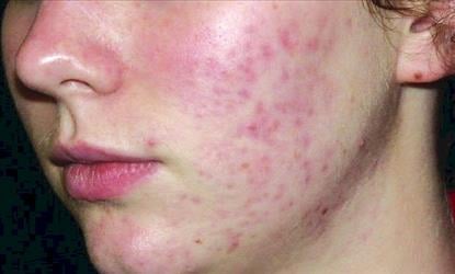 Common summer skin problems and remedies.