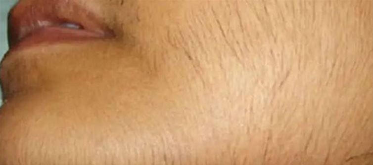 అవాంచిత రొమాలు ఈజీగా పోయే టిప్స్?