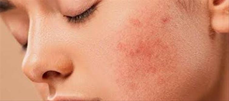 ముఖంపై వేడిమొటిమలు తగ్గే సింపుల్ టిప్స్..!!