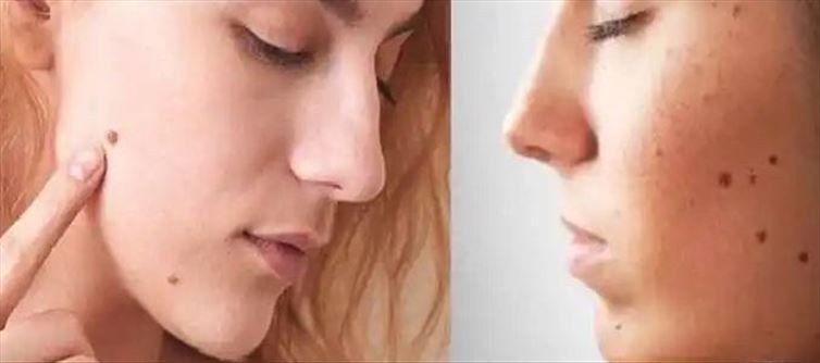 పులిపిర్లు ఇలా చేస్తే ఈజీగా తగ్గుతాయి?