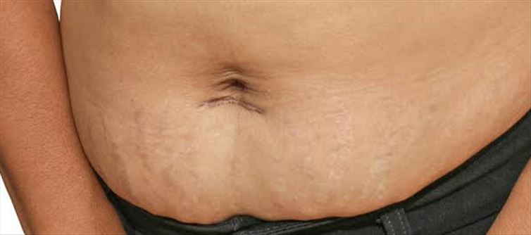 డెలివరీ అయ్యాక బెల్లీ ఫ్యాట్ ని తగ్గించే టిప్?