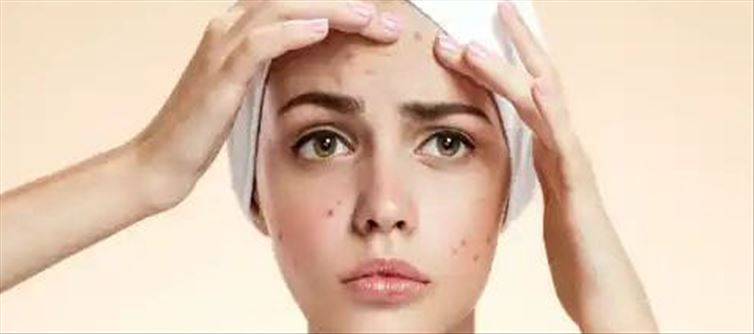 మొటిమలను ఈజీగా నయం చెయ్యాలంటే ఎలా?